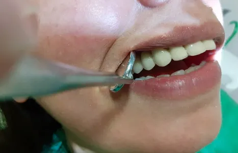 Stomatološko ogledalce odmiče obraz pacijentkinje tokom lečenja zuba
